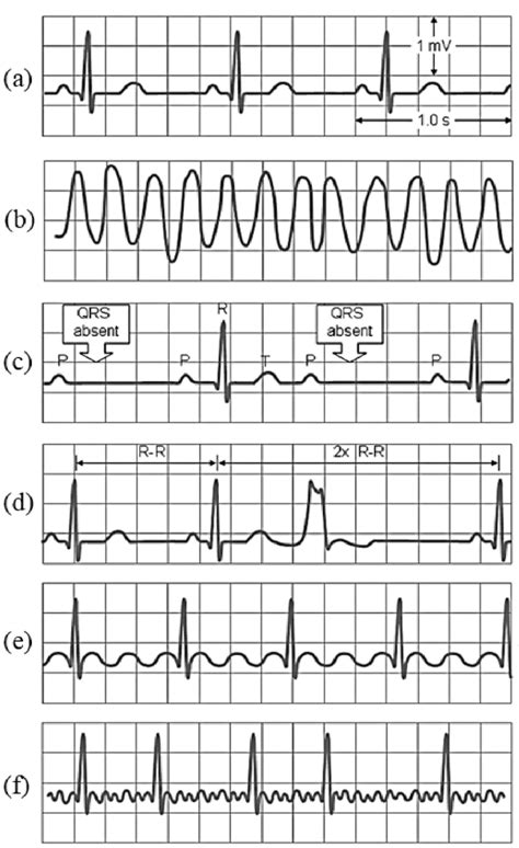 bad ekg readings